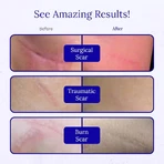 RejuvaSil silicone gel, 30 ml, Scar Heal