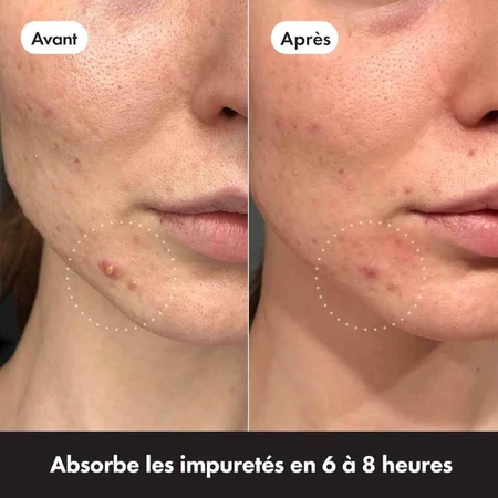 Hero Mighty Patch Acne pleisters Invisible+ x24