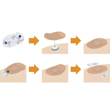 CureTape sensorpleisters, CGM-sensorpleisters voor glucosemonitoring, kleurenmix, 8 stuks
